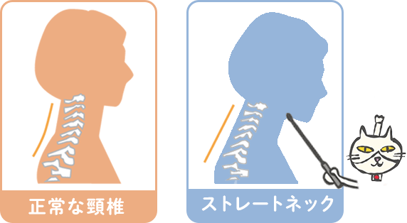 正常な頸椎とストレートネックの比較イラスト
